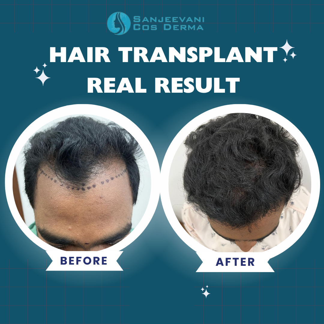 Hair Transplant Real Result 1