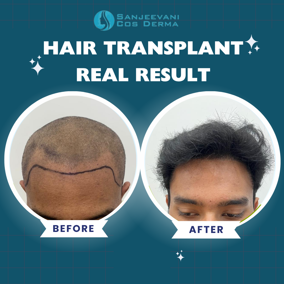 Hair Transplant Real Result 10