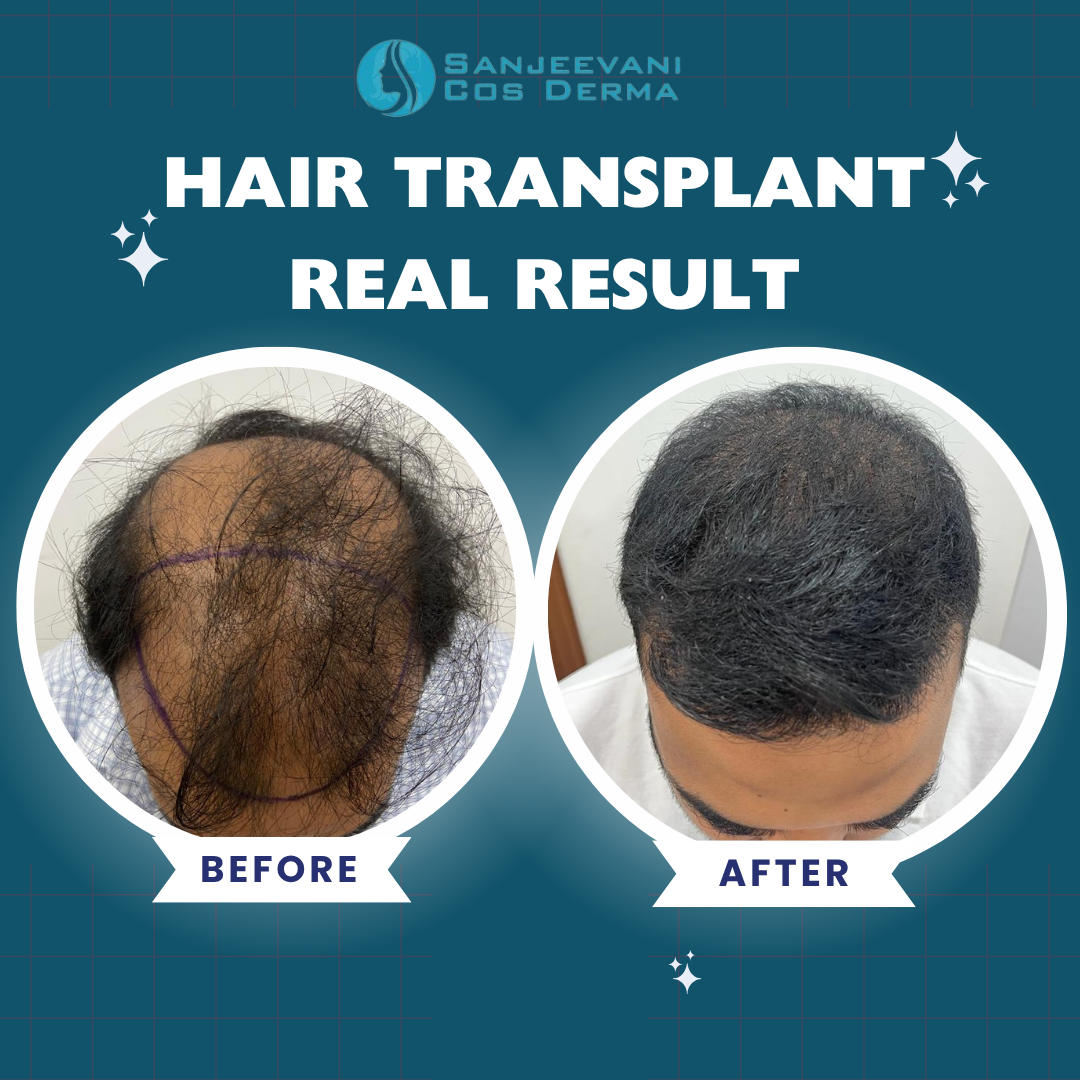 Hair Transplant Real Result 2
