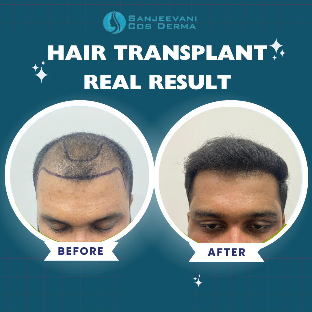 Hair Transplant Real Result 3