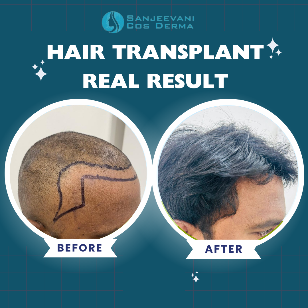 Hair Transplant Real Result 4