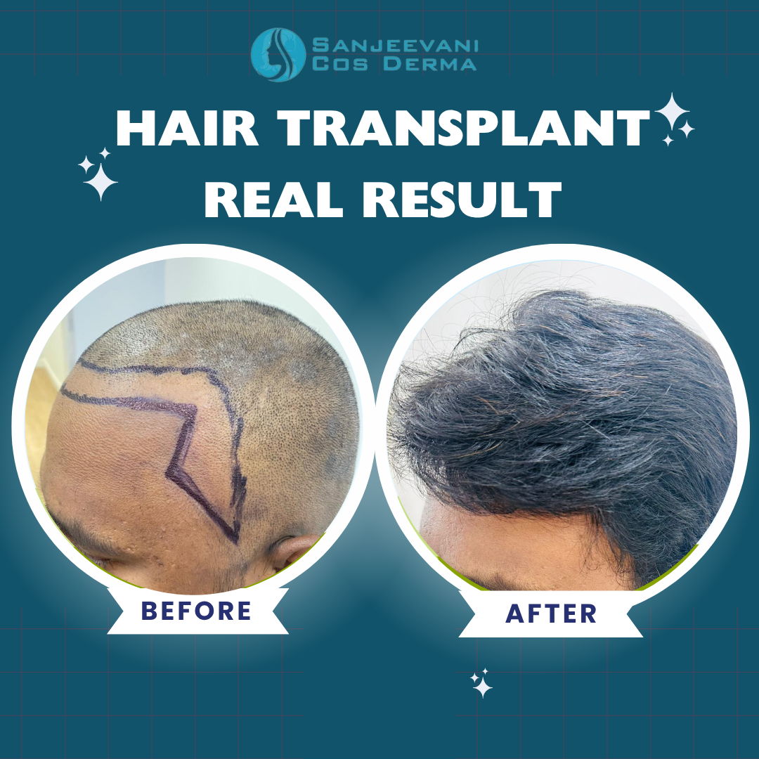 Hair Transplant Real Result 5