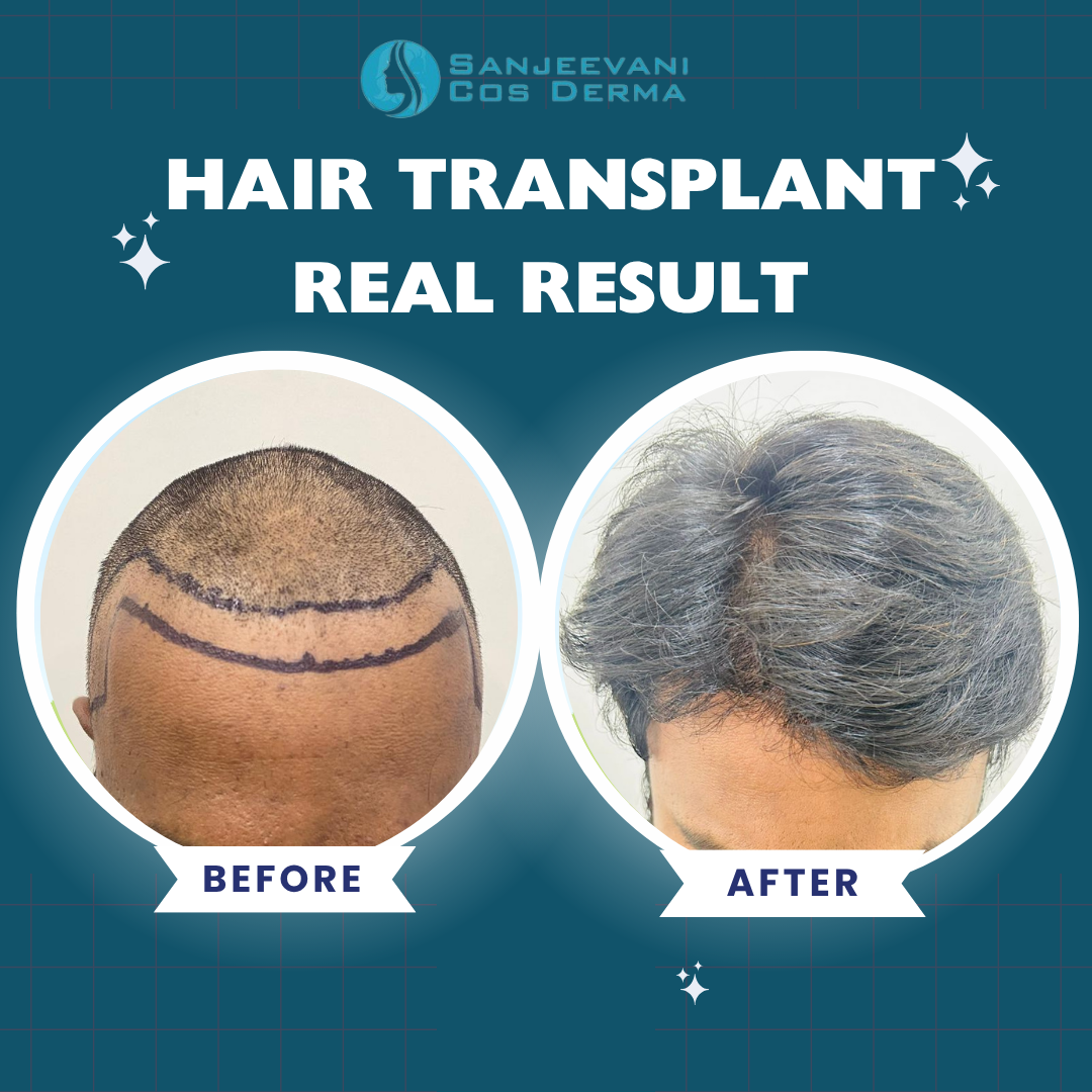 Hair Transplant Real Result 7