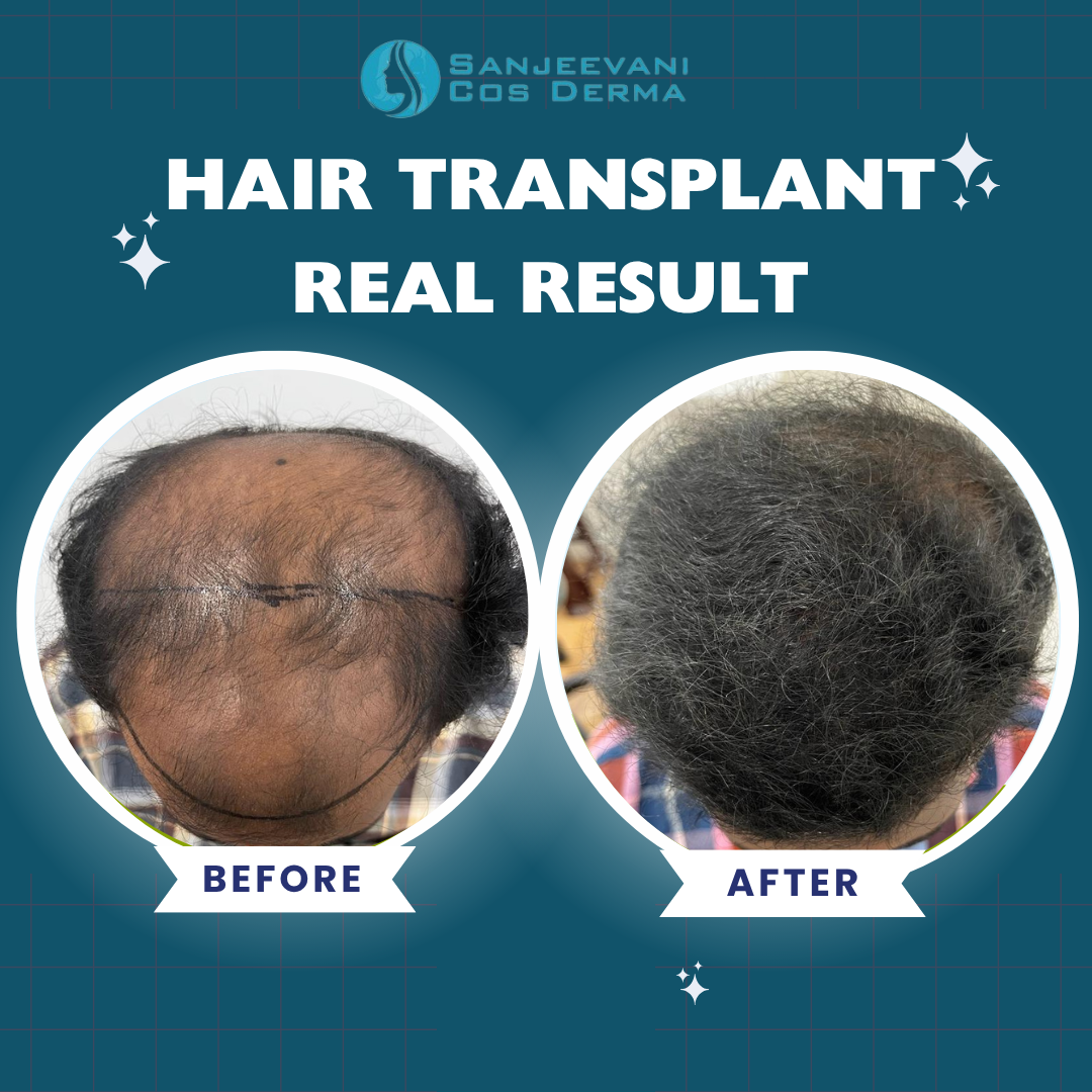 Hair Transplant Real Result 8