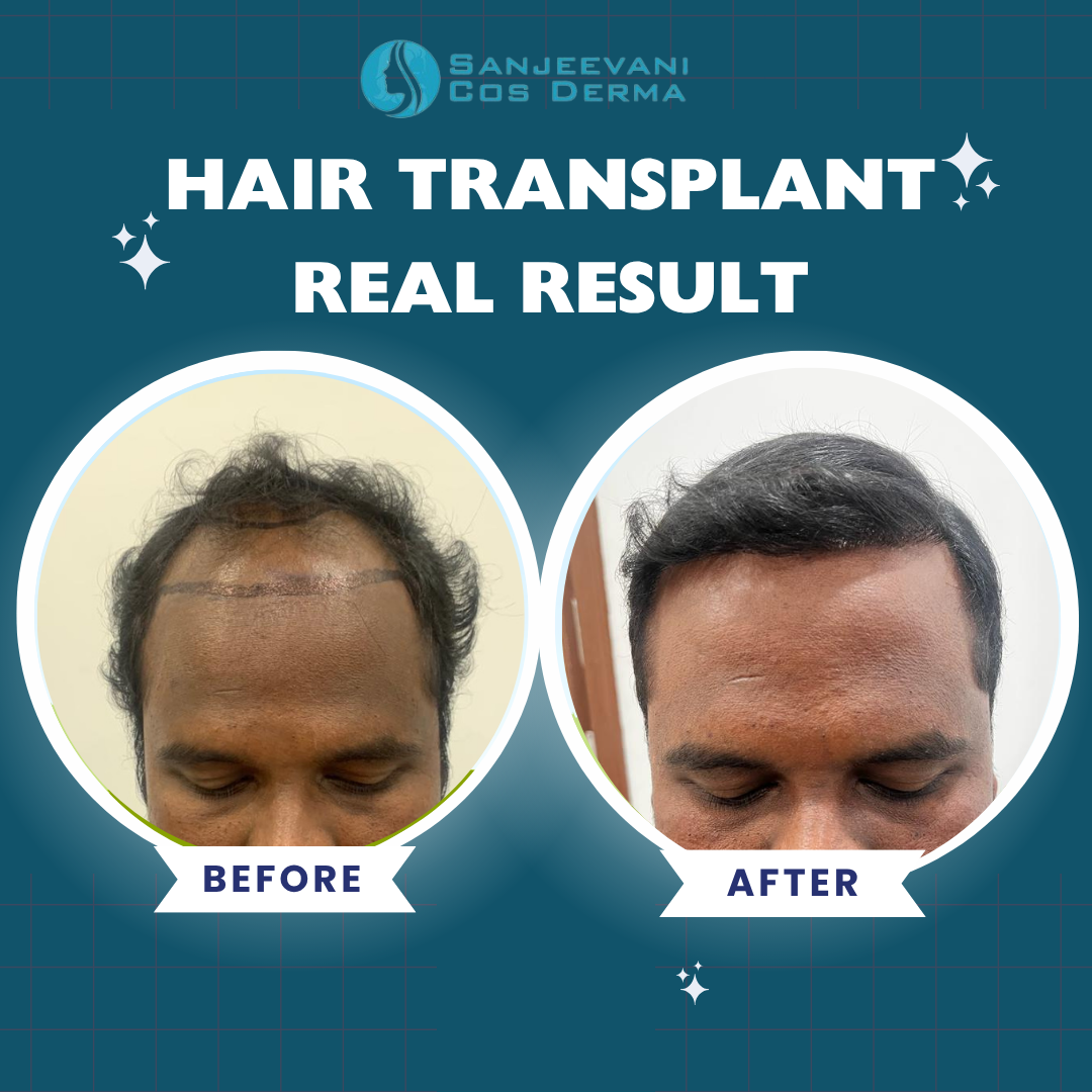 Hair Transplant Real Result 9
