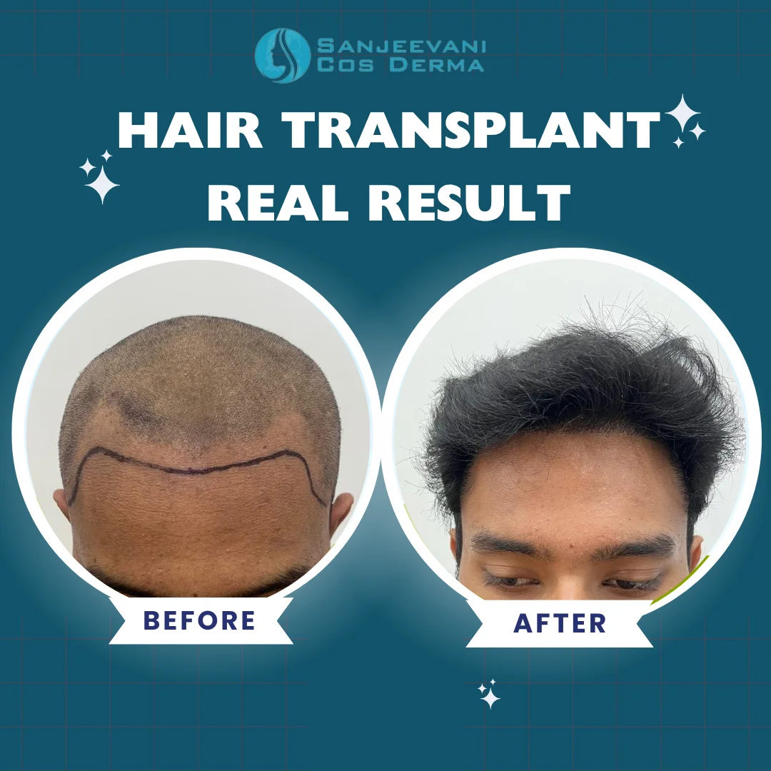Hair Transplant Result 10 - Before and After at Sanjeevani Cos Derma Bangalore