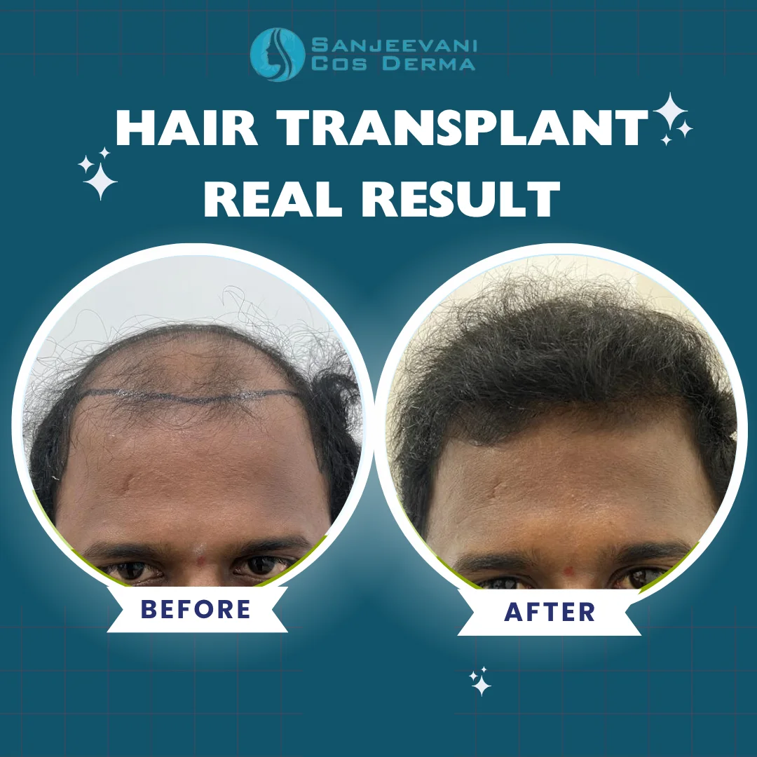 Hair Transplant Result 12 - Before and After at Sanjeevani Cos Derma Bangalore