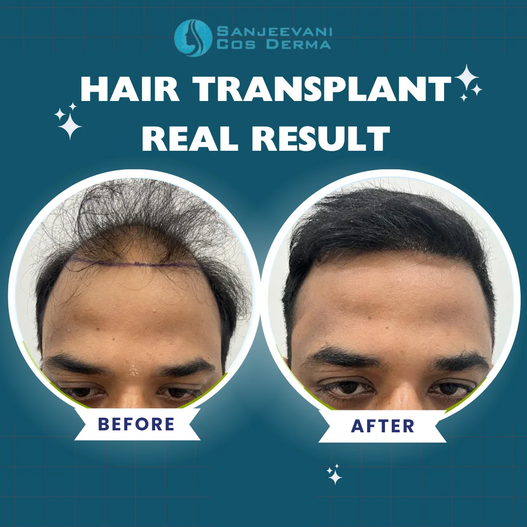 Hair Transplant Result 13 - Before and After at Sanjeevani Cos Derma Bangalore