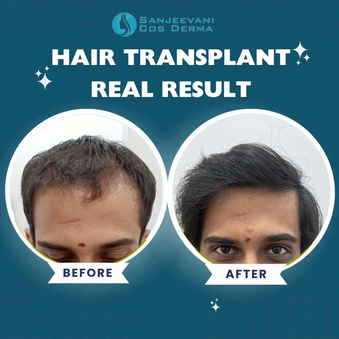 Hair Transplant Result 14 - Before and After at Sanjeevani Cos Derma Bangalore