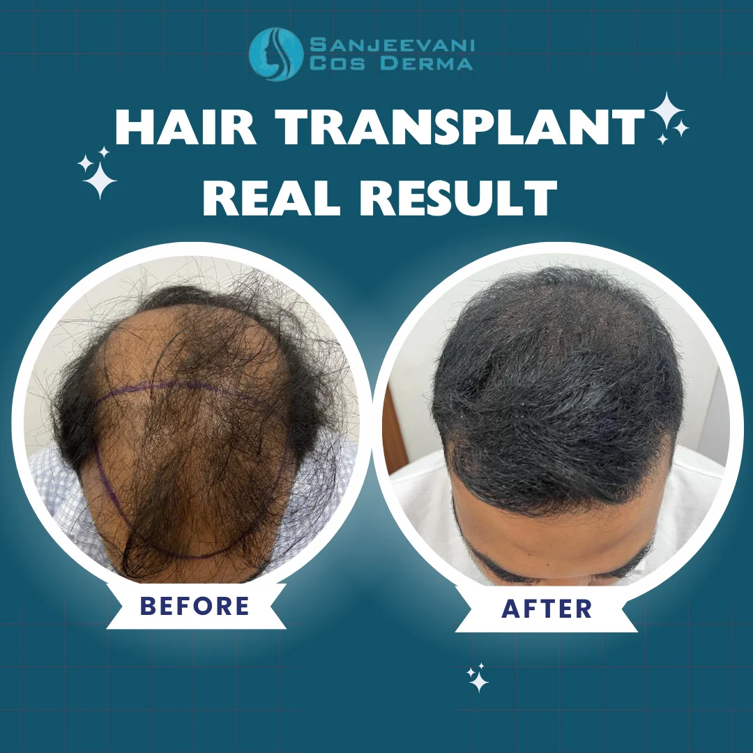 Hair Transplant Result 2 - Before and After at Sanjeevani Cos Derma Bangalore