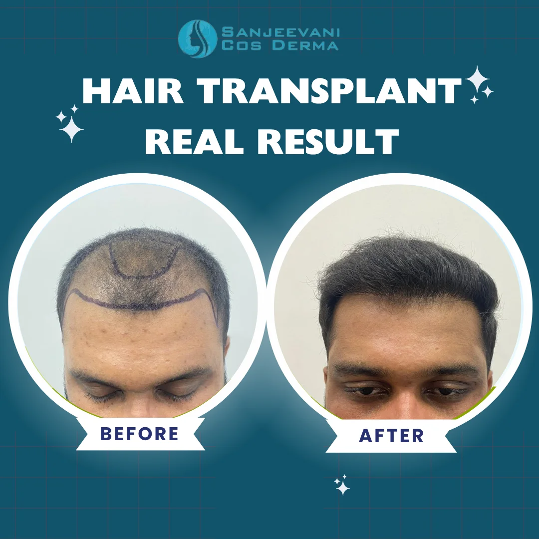 Hair Transplant Result 3 - Before and After at Sanjeevani Cos Derma Bangalore