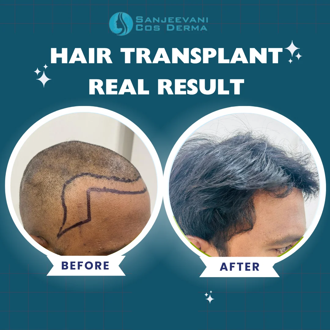 Hair Transplant Result 4 - Before and After at Sanjeevani Cos Derma Bangalore