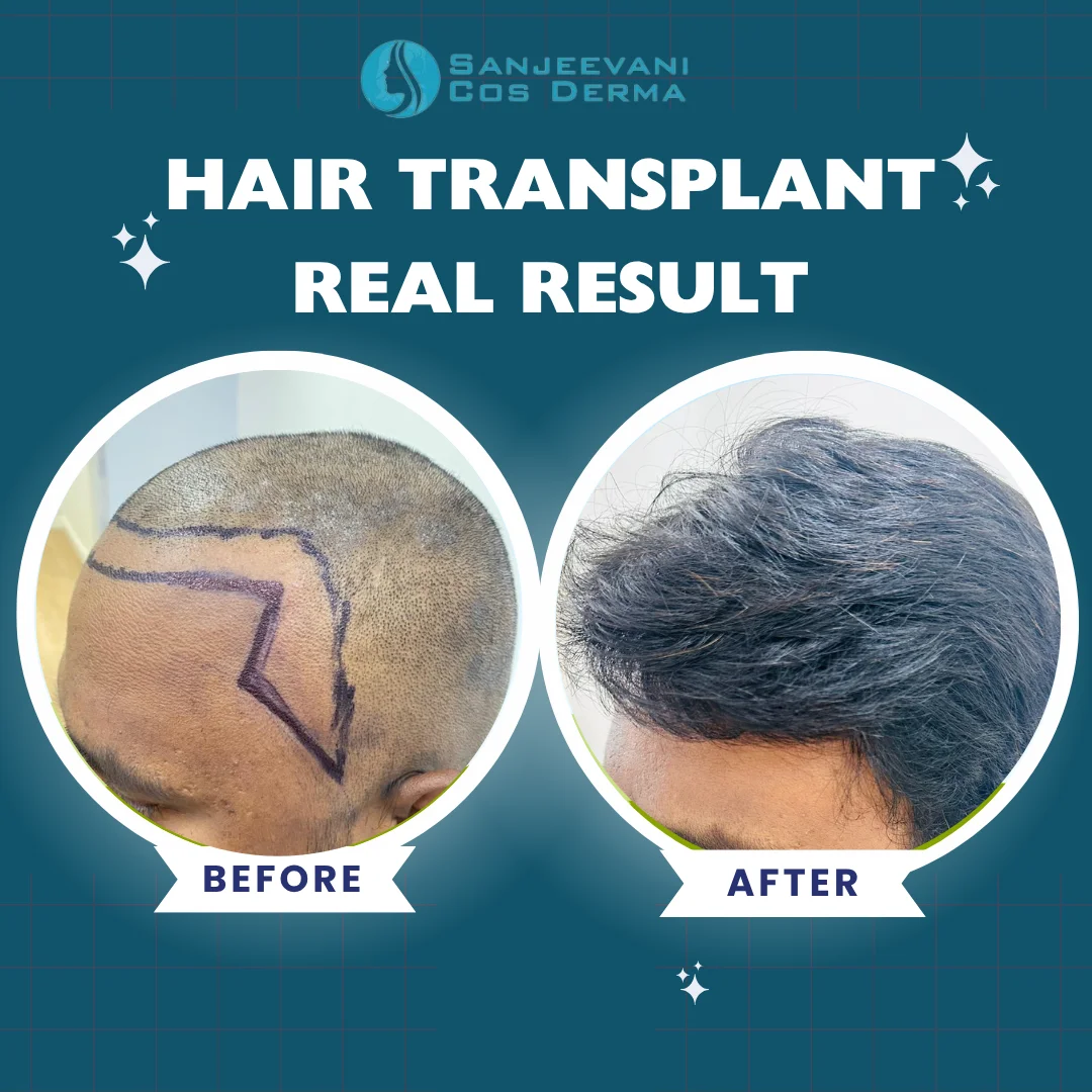 Hair Transplant Result 5 - Before and After at Sanjeevani Cos Derma Bangalore