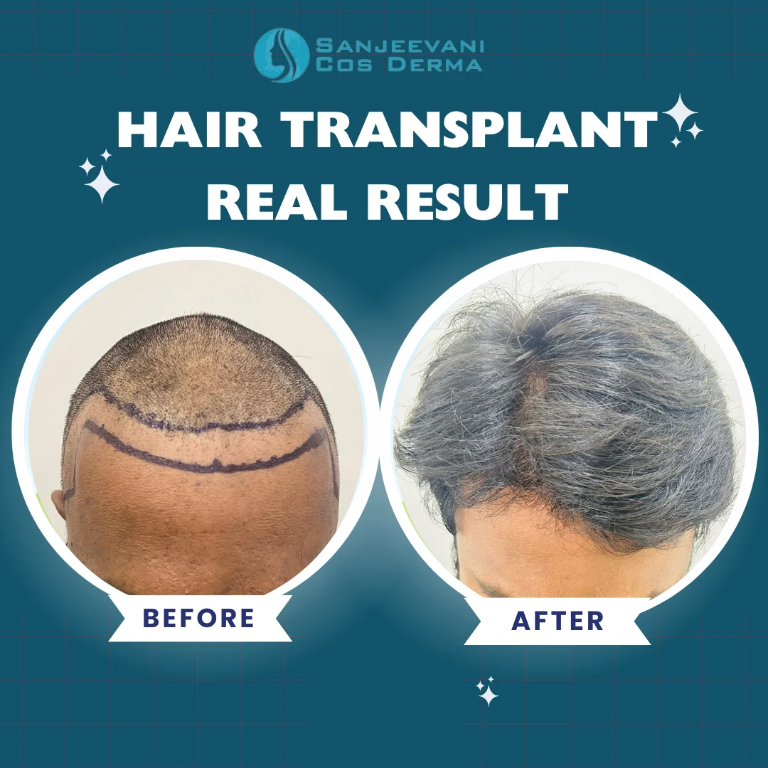 Hair Transplant Result 6 - Before and After at Sanjeevani Cos Derma Bangalore