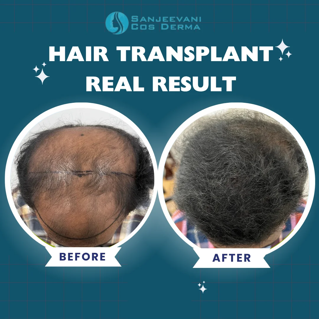 Hair Transplant Result 8 - Before and After at Sanjeevani Cos Derma Bangalore