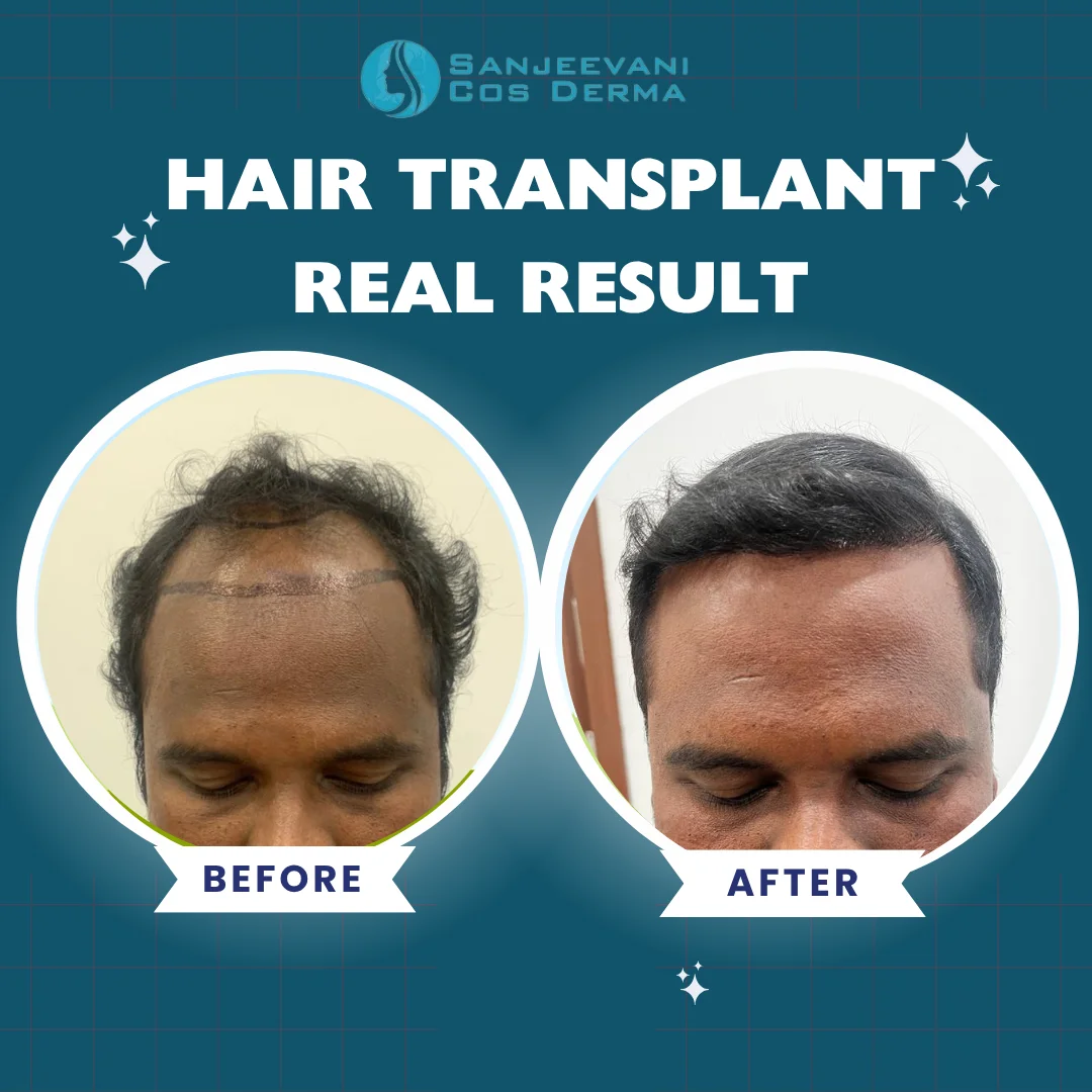 Hair Transplant Result 9 - Before and After at Sanjeevani Cos Derma Bangalore