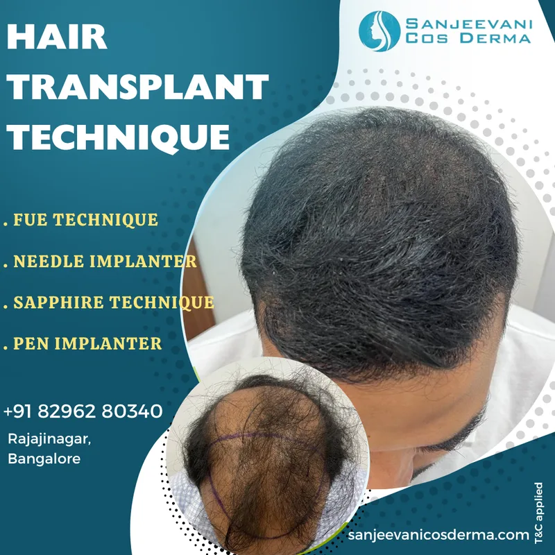 FUE Hair Transplant - Advanced Technique - Before and After