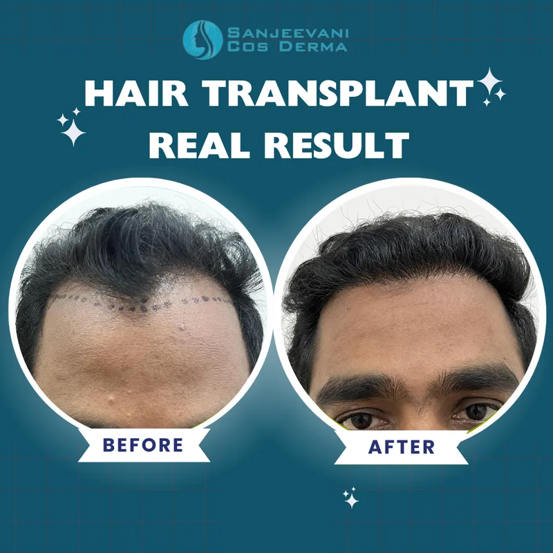 Hair Transplant - Impressive Regrowth - Before and After