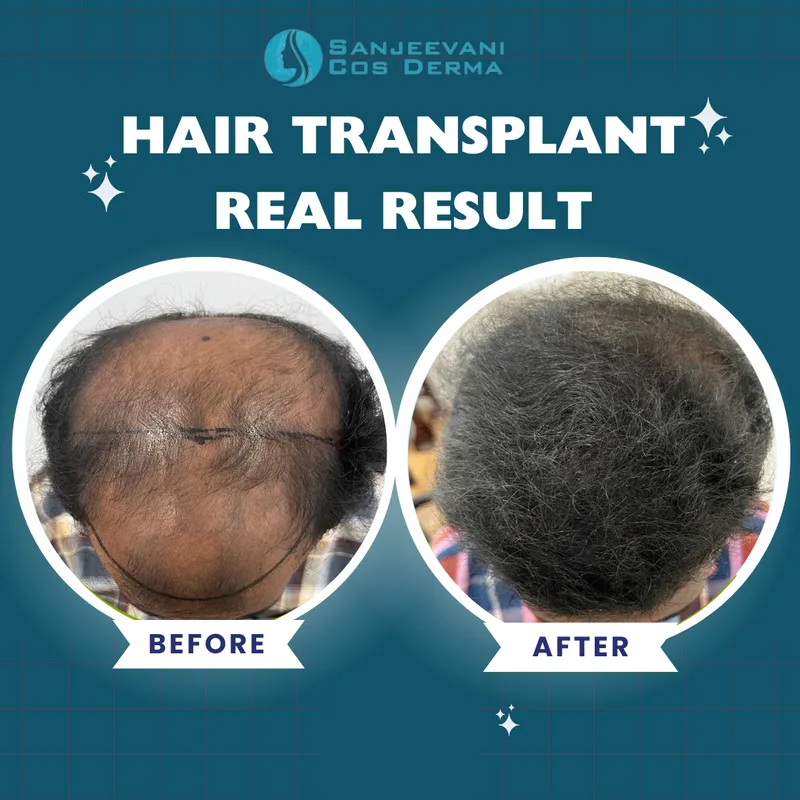 Hair Transplant - Full Crown Coverage - Before and After