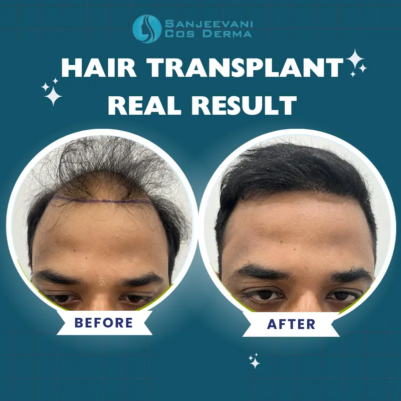 Hair Transplant - Dense Growth Results - Before and After