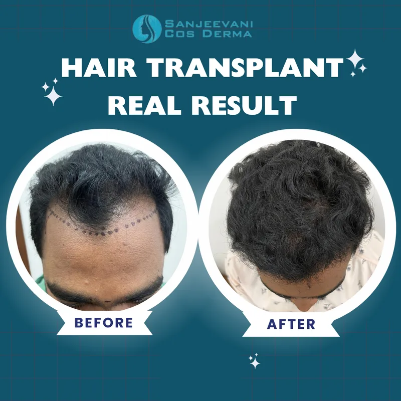 Hair Transplant - Amazing Transformation - Before and After