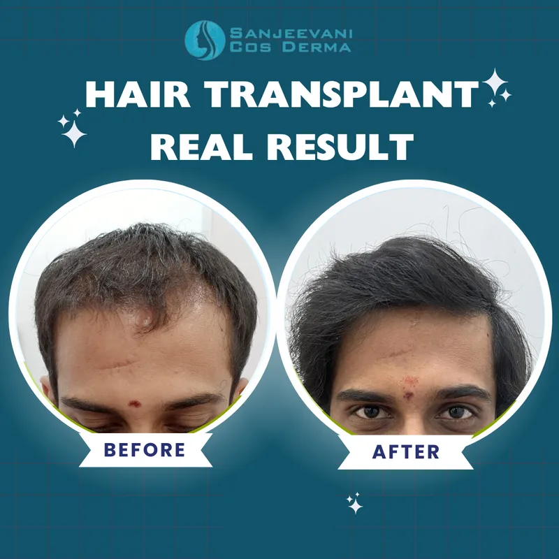 Hair Transplant - Complete Restoration - Before and After