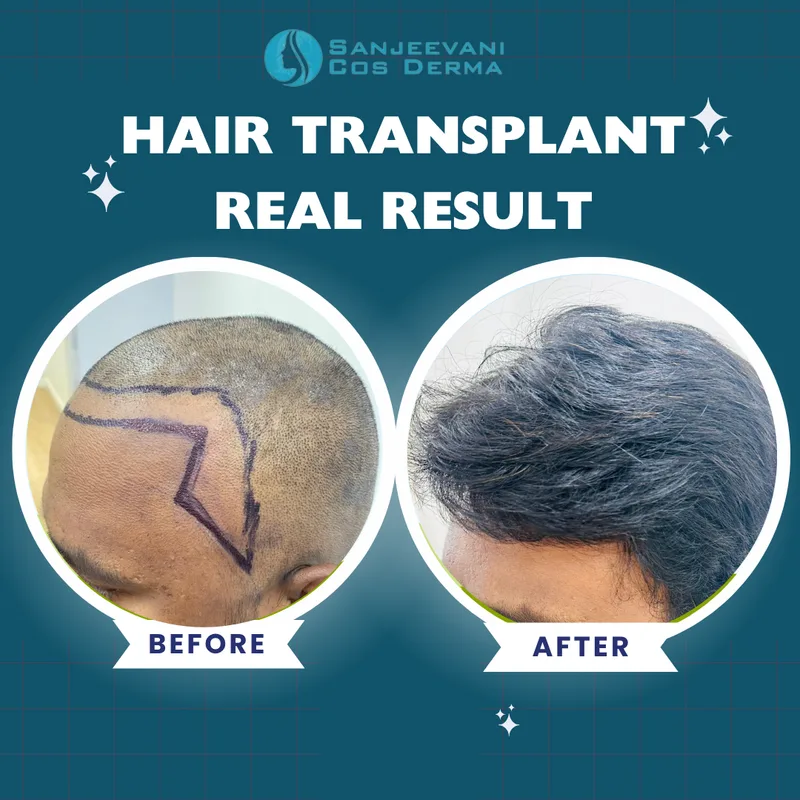 Hair Transplant - High Density - Before and After